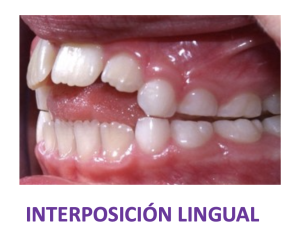 Interposición lingual
